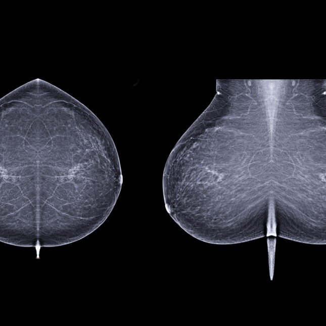 STAT+: Why this startup is taking its AI to predict breast cancer risk directly to patients