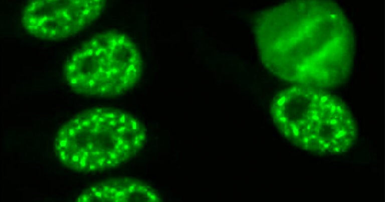 autoimmunity-may-be-rising-in-the-united-states