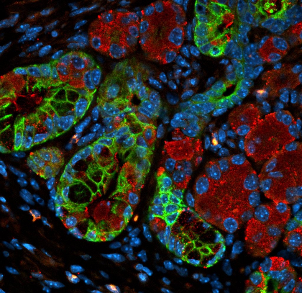 stat+:-verastem’s-kras-inhibitor-shows-promise-in-pancreatic-cancer